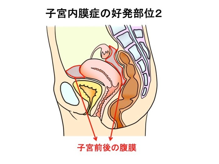 ひどい生理痛や不妊症の原因にも…「子宮内膜症」ってどんな病気？症状やメカニズムを知っておこうの画像6