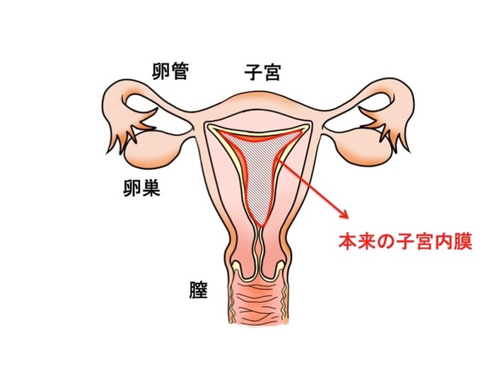 ひどい生理痛や不妊症の原因にも…「子宮内膜症」ってどんな病気？症状やメカニズムを知っておこうの画像2