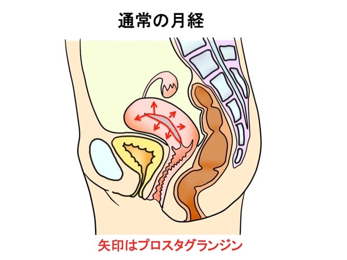 ひどい生理痛や不妊症の原因にも…「子宮内膜症」ってどんな病気？症状やメカニズムを知っておこうの画像7