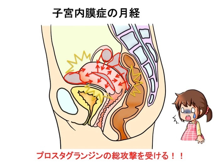 ひどい生理痛や不妊症の原因にも…「子宮内膜症」ってどんな病気？症状やメカニズムを知っておこうの画像8