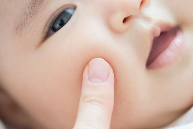 赤ちゃんのあせもをどうにかしたい！あせもの原因や予防法を紹介のタイトル画像